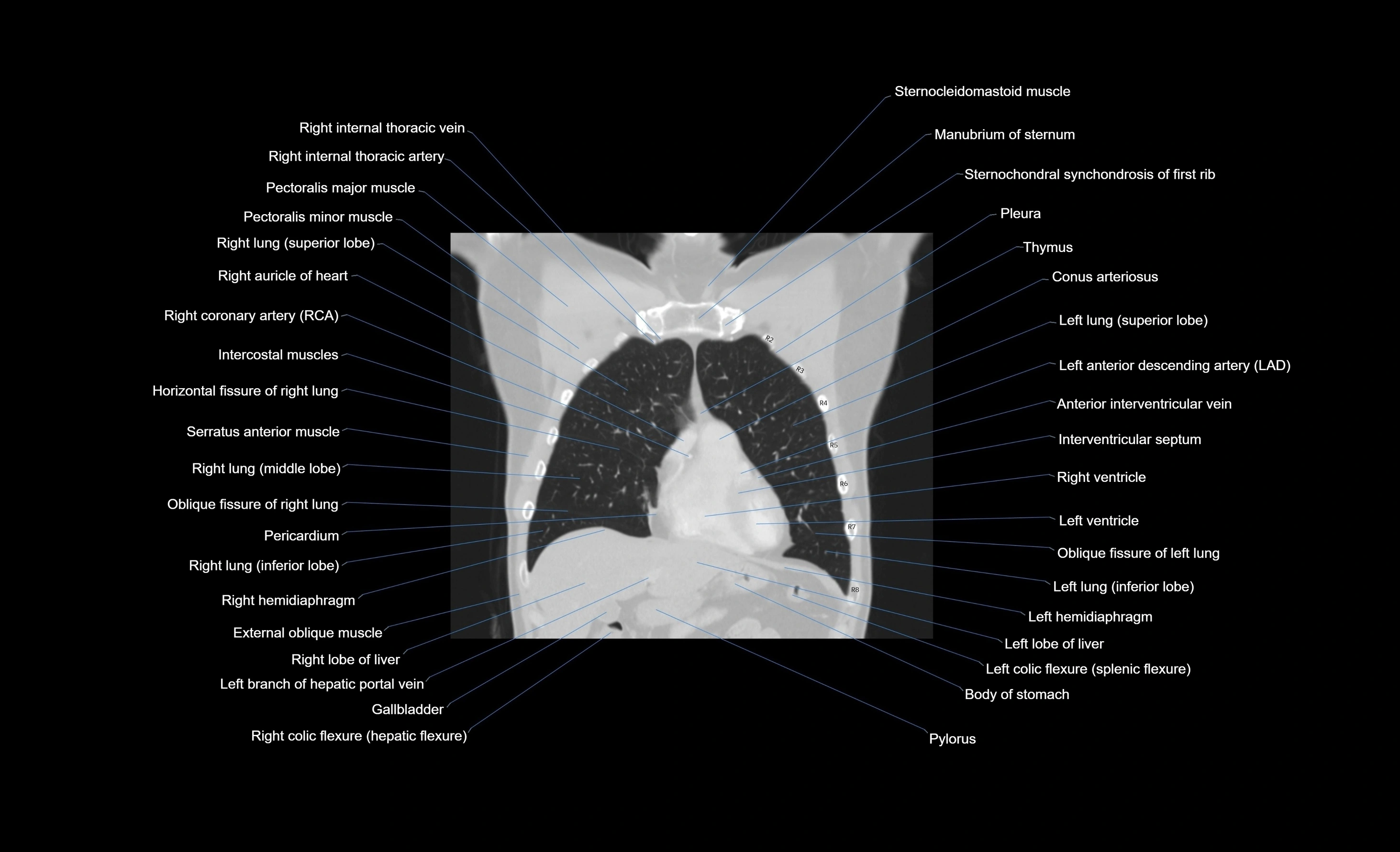 CT chest (thorax) labelled coronal cross sectional anatomy radiology image-00086.webp